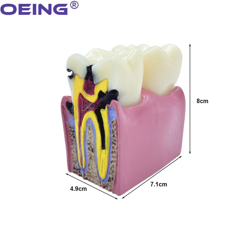 OEING 1Pc Dental Teaching Teeth Model 6 Times Dental Caries Model For Dental Demonstration Model Lab Oral Research Tool