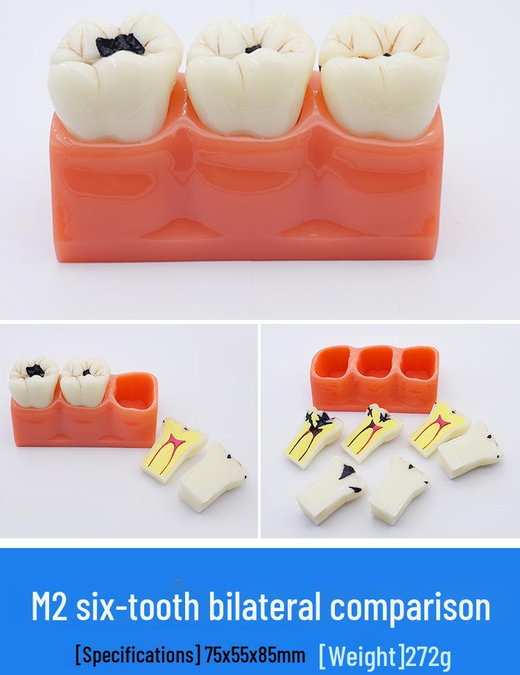Dental Educational and Communication Model Set: Comprehensive, Removable, and Implant Restoration Models