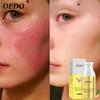 OEDO Hyaluronsäure Ginseng Feuchtigkeitsspendende Lotion Hautpflege Aufhellung Akne Behandlung Tiefe Haut Reparatur Gesichtspflege Öl-kontrollierende Wirkung