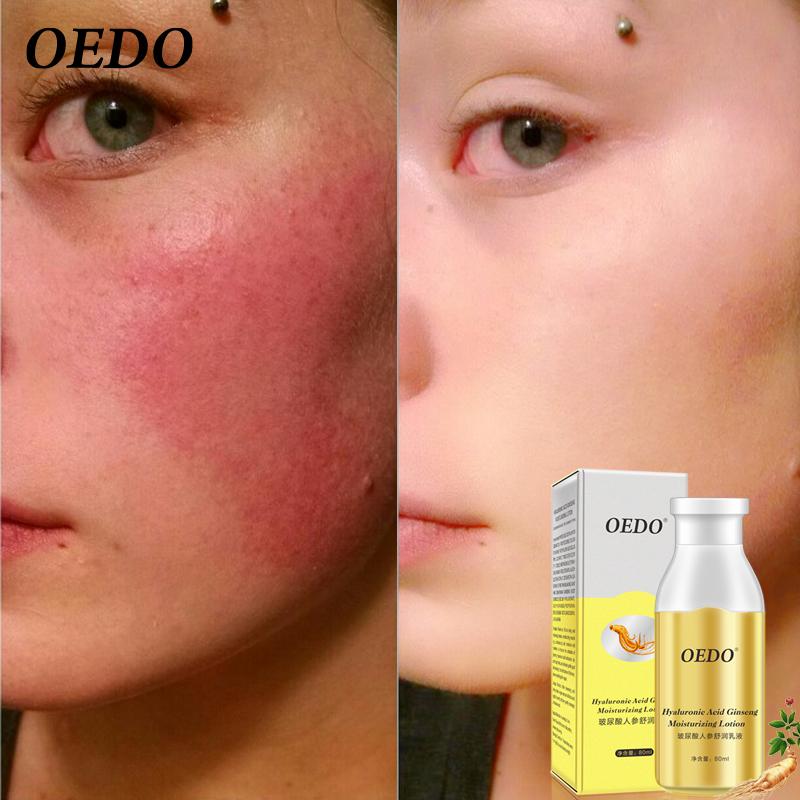OEDO Hyaluronsäure Ginseng Feuchtigkeitsspendende Lotion Hautpflege Aufhellung Akne Behandlung Tiefe Haut Reparatur Gesichtspflege Öl-kontrollierende Wirkung