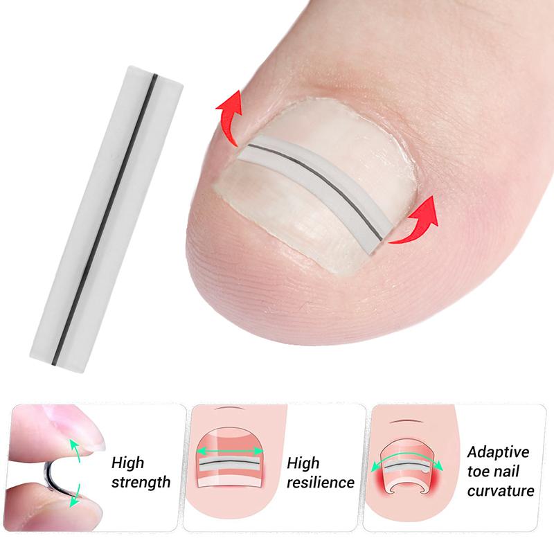 Ingrown Toenail Correction Tool Straightening Clip Brace Ingrown Toe Nail Treatment Elastic Patch Sticker Pedicure Tool