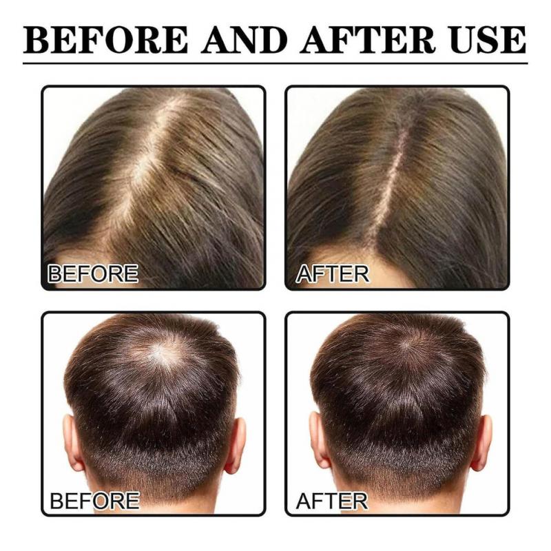 Hair Growth Serum, Jaysuing: Prevents Hair Loss, Nourishes Dry and Damaged Hair, Promotes Natural Hair Growth, and Prevents Hair Loss