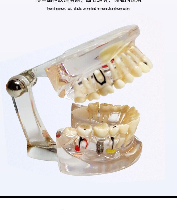 Human Tooth Anatomy Model for Teaching and Simulation - Detachable Denture Mold