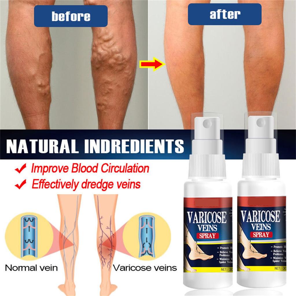 Sprej na křečové žíly, sprej na křečové žíly, sprej na křečové žíly 30 ml