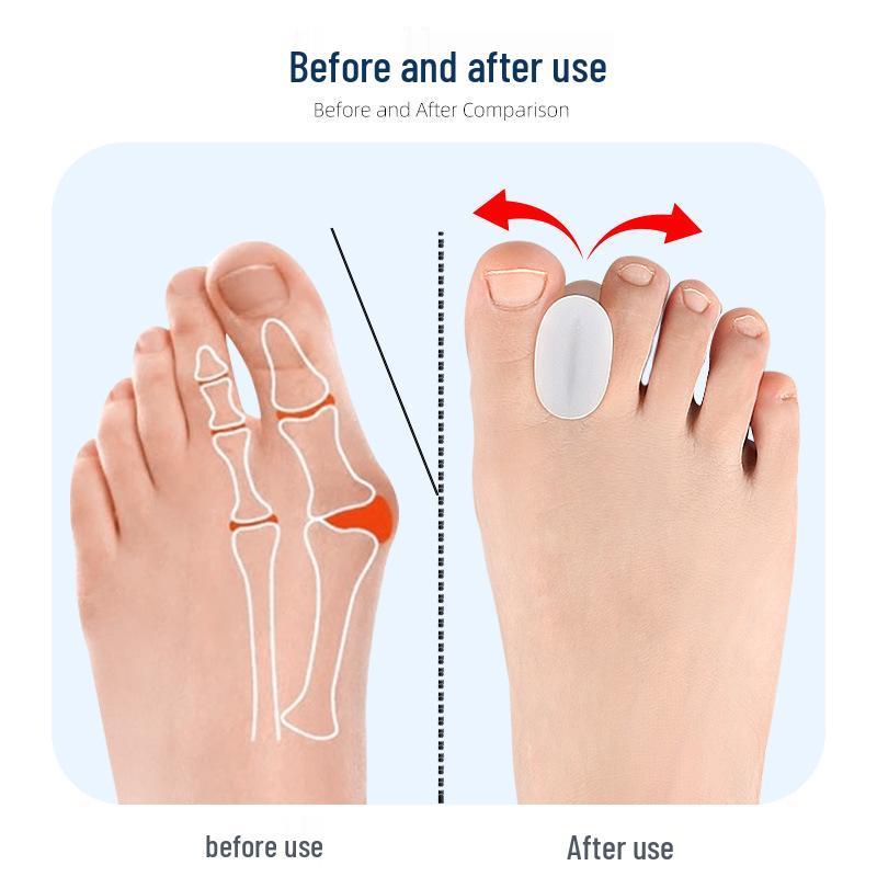 Silicone Hallux Valgus Corrector & Toe Separator for Daily Use