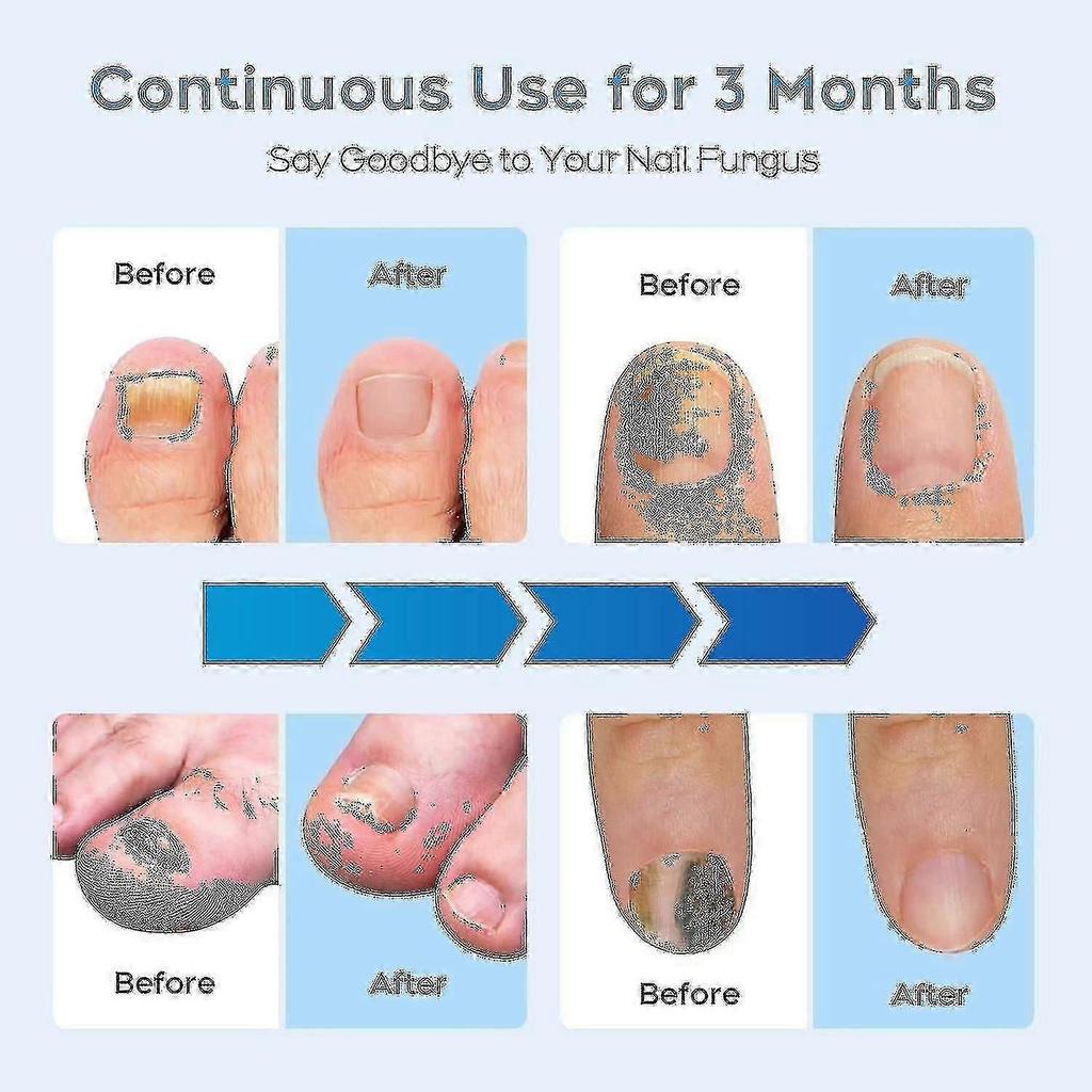 2024 Nail Fungus Laser Treatment Device Compatible with Multiple Toenail, Home Use 905nm Infrared Light + 470nm Blue Light Toe Nail