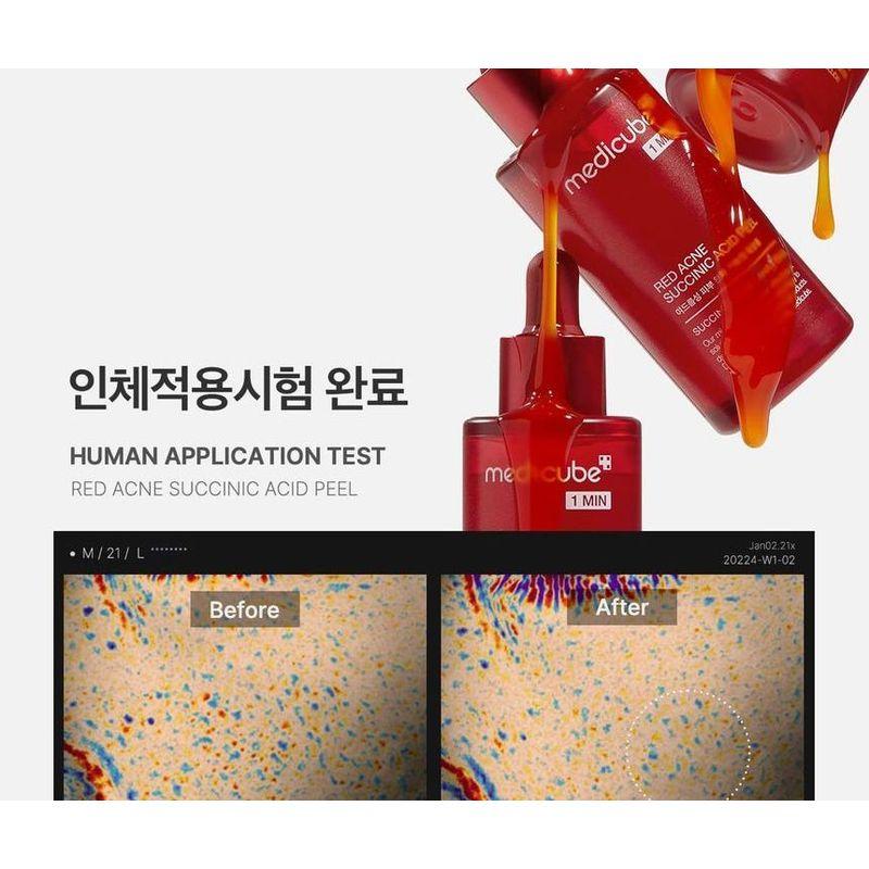 medicube - Red Acne Succinic Acid Peel