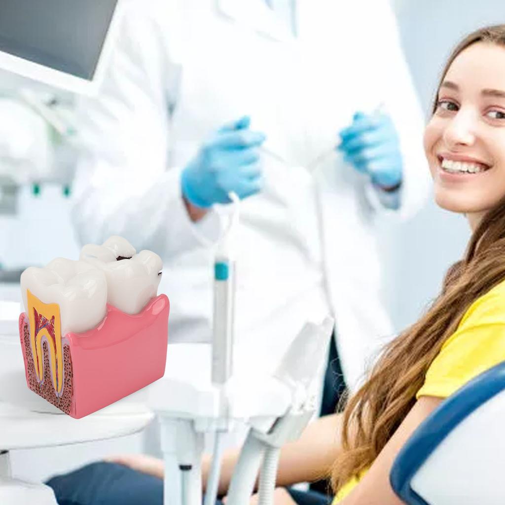 Dental Caries Model Tooth 6X Decay Demonstration Model for Teaching Study Laboratories