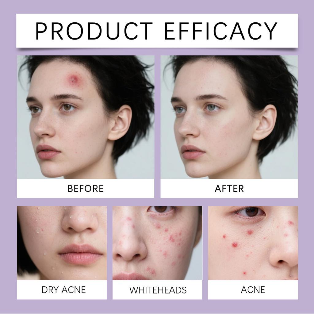 144 Stück Halloween Akne-Patches Hydrokolloid Akne-Patches, Entzündungshemmend, Rötungslindernd und Beruhigende Pflege-Patches