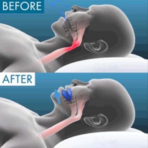 Anti-Snoring Mouthpiece, Teeth Grinding Relief, Adjustable Night Mouthguard, Improves Sleep, Prevents Snoring, Sleep Guard, Protects Teeth, Unisex