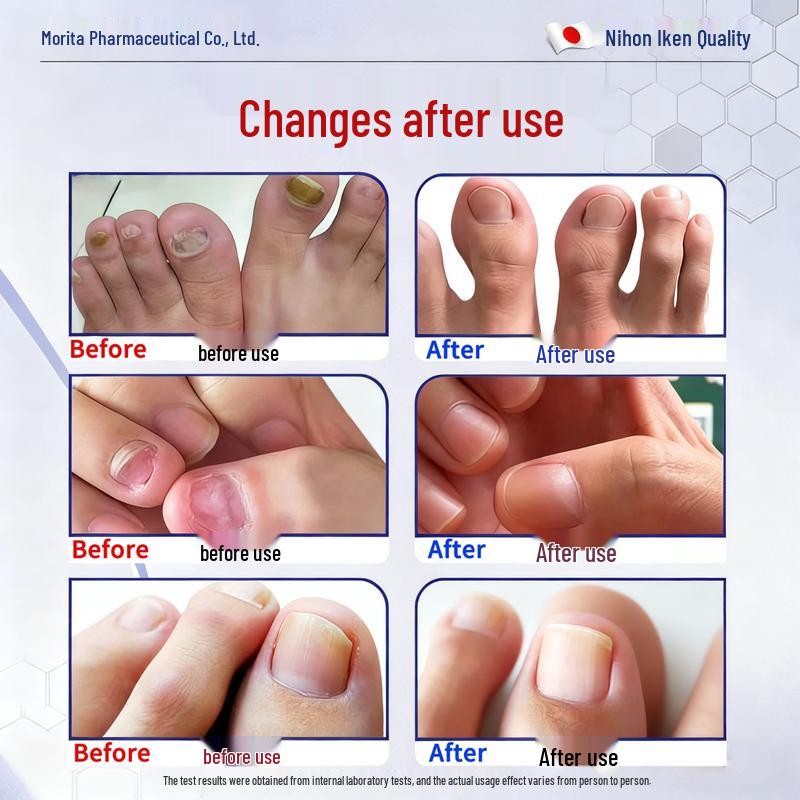 Que Yi Shi Jia Antifungal Nail Repair Solution