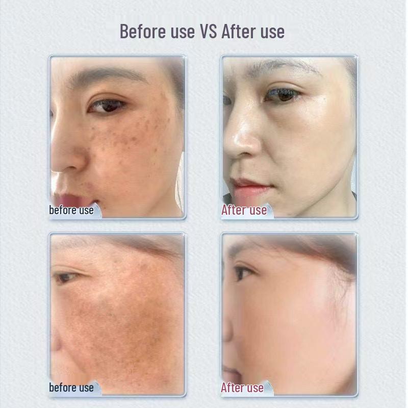 Freckle Removal & Brightening Serum: Fade Spots, Firm, and Brighten Skin - Exclusive for Beauty Salons.