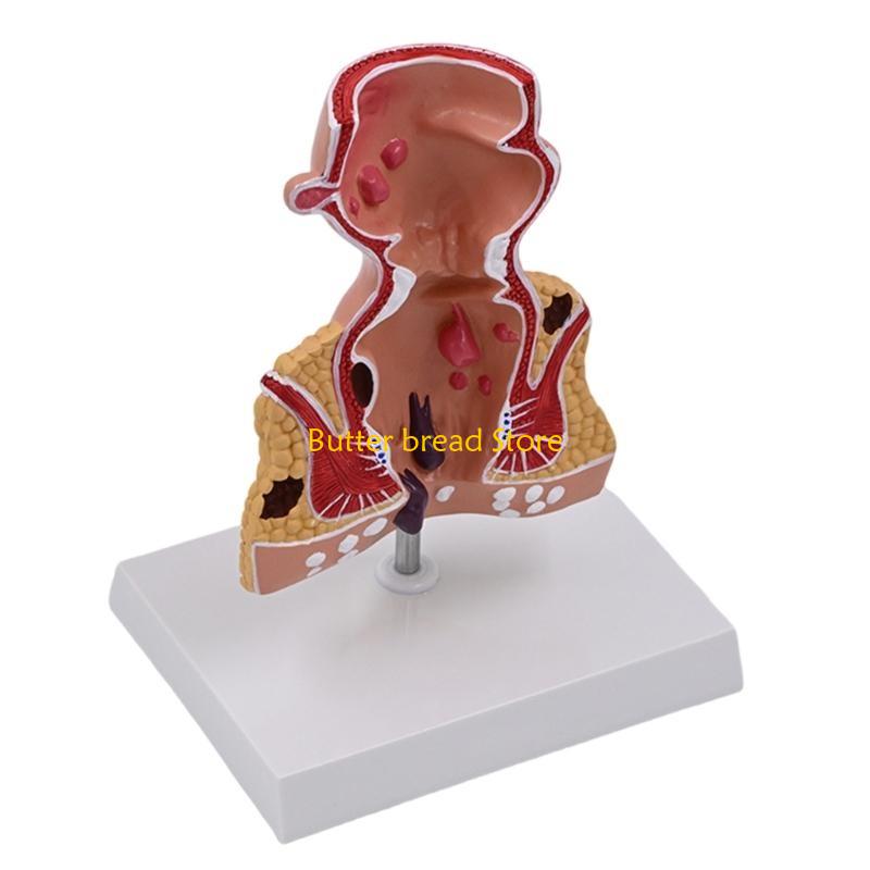 W89C Human Pathologies of Rectum Model Medicals Teaching Tool Human Rectum Model Human Anatomy Model Teaching Supplies