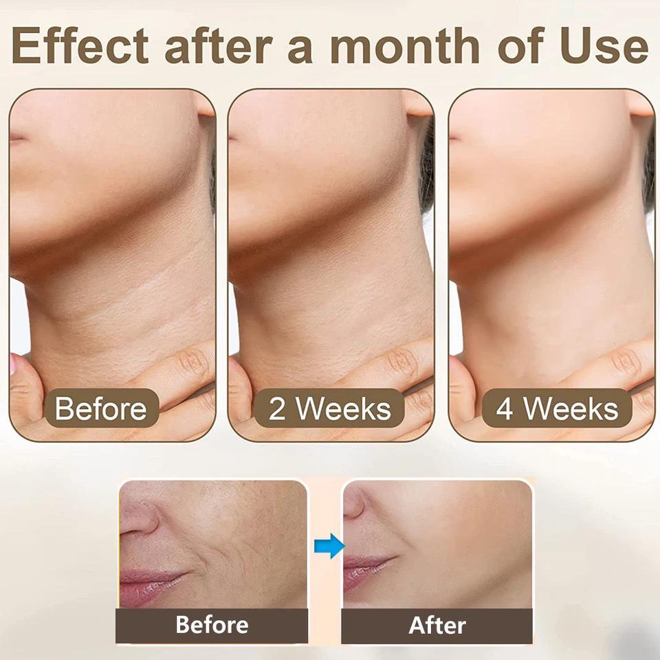 Beautiful EMS Microcurrent Neck & Face Lifting Device - Reduces Neck Lines & Nasolabial Folds, Enhances Firmness with Light Therapy.