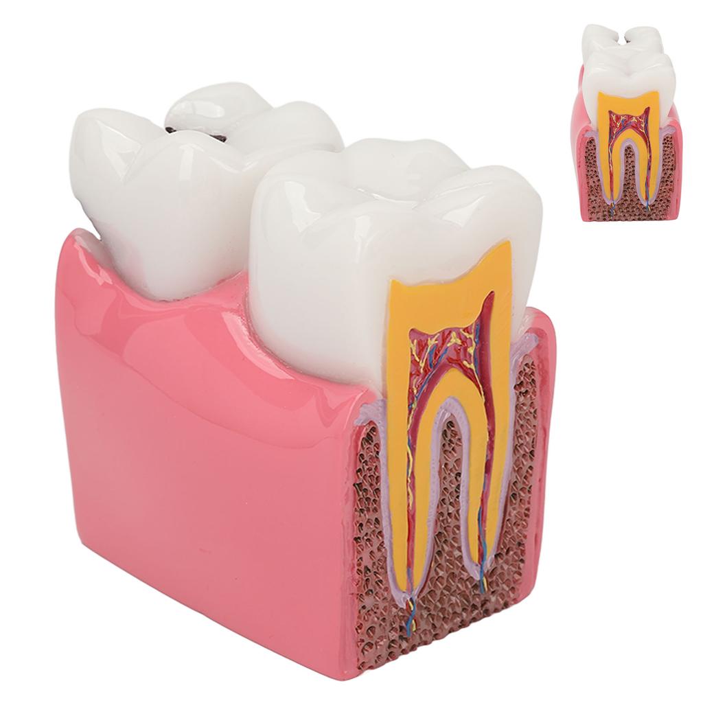 Dental Caries Model Tooth 6X Decay Demonstration Model for Teaching Study Laboratories
