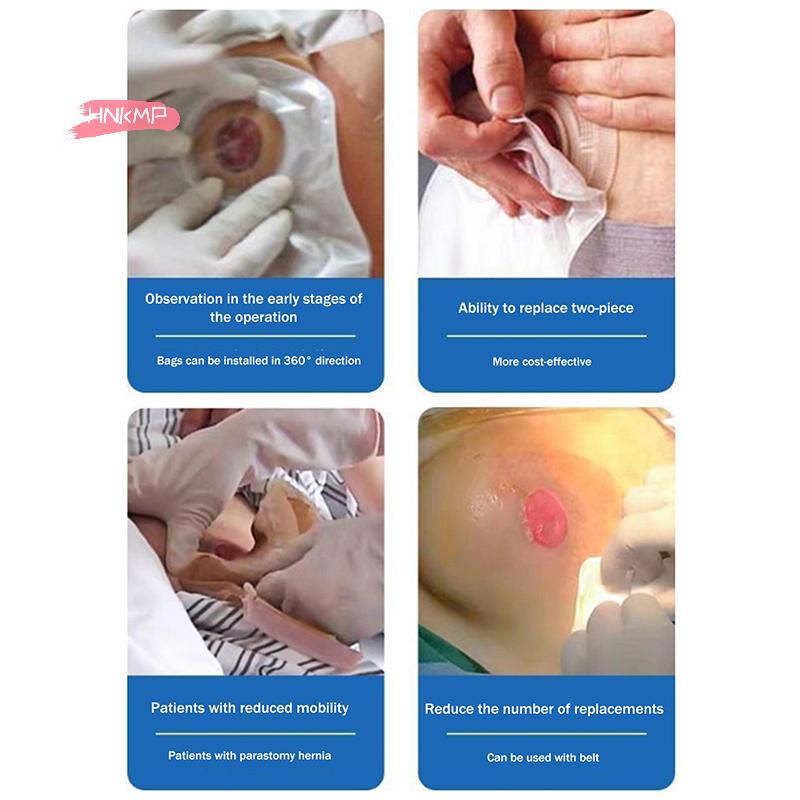 Disposable Ostomy Bags with Skin Stoma Rings Leakproof Barriers Baseplates Activated Carbon Sheet Lining for Safe Daily Use