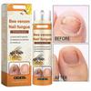 Suitable for Nail Repair Serum, Bee Venom Care Spray, Ingrown Toenail Solution