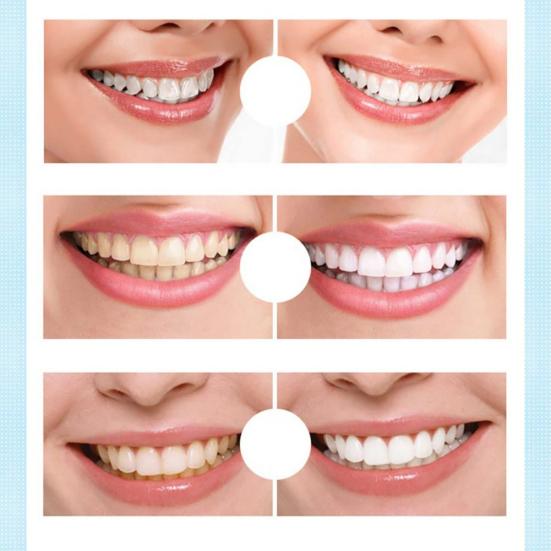 Bärbar tandblekningspenna fläckar Plackborttagning av tandvård blekningsgel