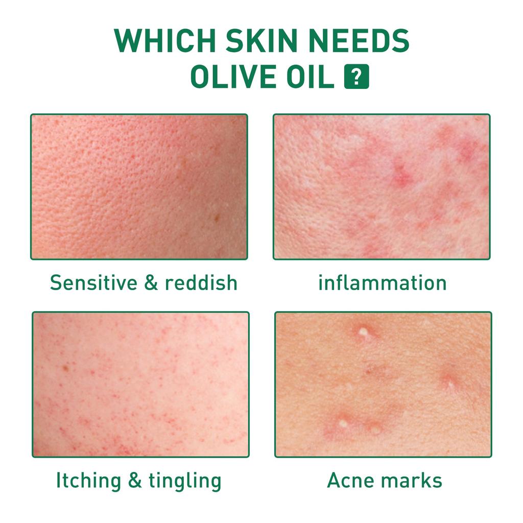 Tea Tree Oil Acne Serum 30ml Moisturizing for All Skin Types Gentle Repair Oil Control Balancing Essence Cream
