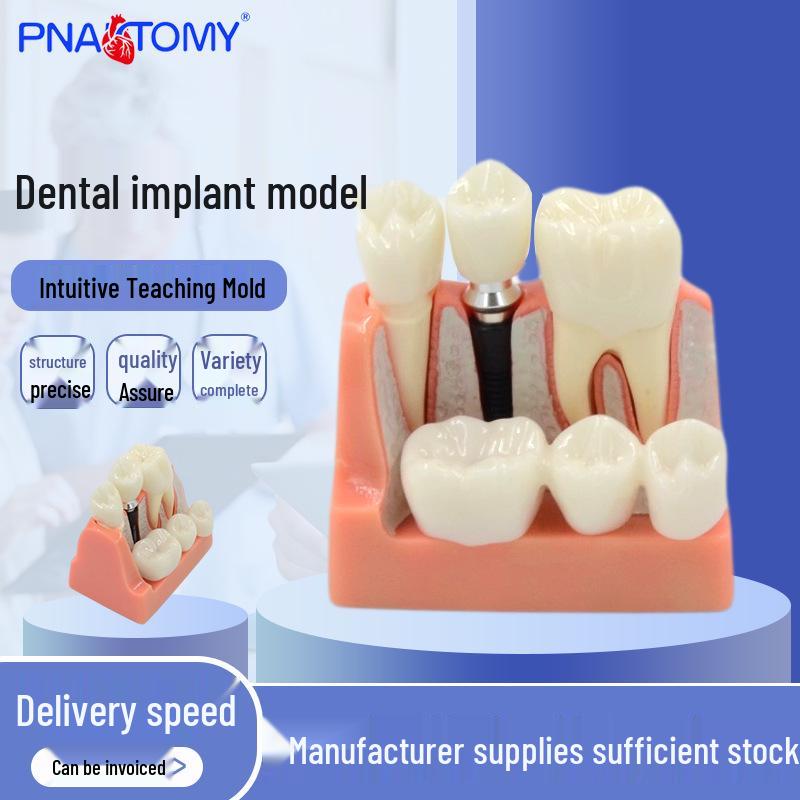 Transparent Dental Implant & Human Oral Cavity Teeth Model 9.3*6.2*9 cm