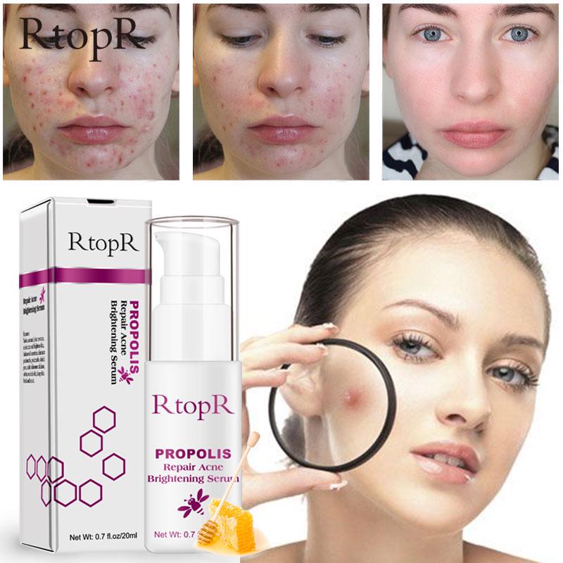 Propolis Reparasjon Akne Lysende Serum Akne Arr Flekker Rengjøring Serum Krympe porene Eliminerer Akne Behandling Oljekontroll