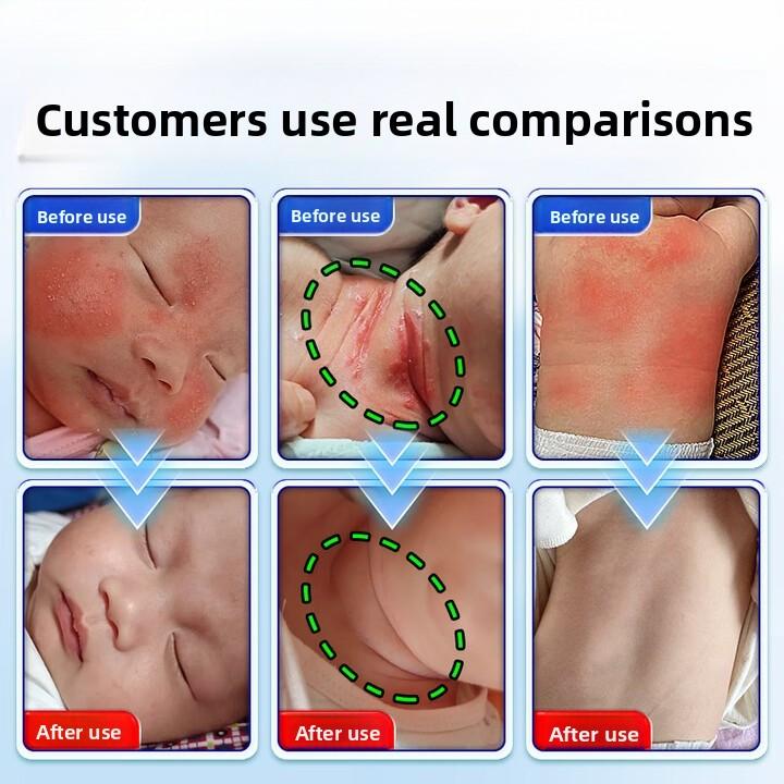 Itch Relief Fast! Anti-Itch Cream for Urticaria & Skin Allergies - Soothes Hives, Rashes On Body, 50g