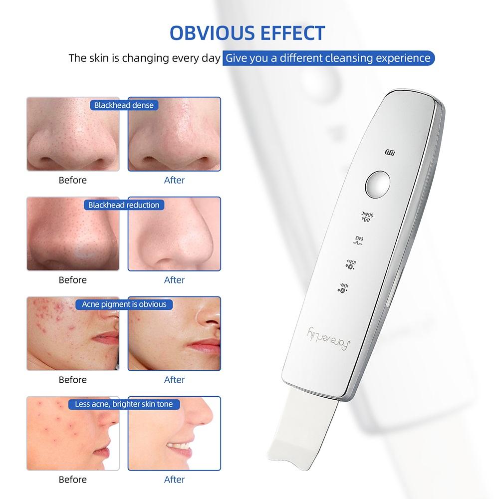Ultrasonic Skin Scrubber Vibration Beauty Machine EMS Facial Peeling Ion Pore Clean Remove Blackhead Exfoliation
