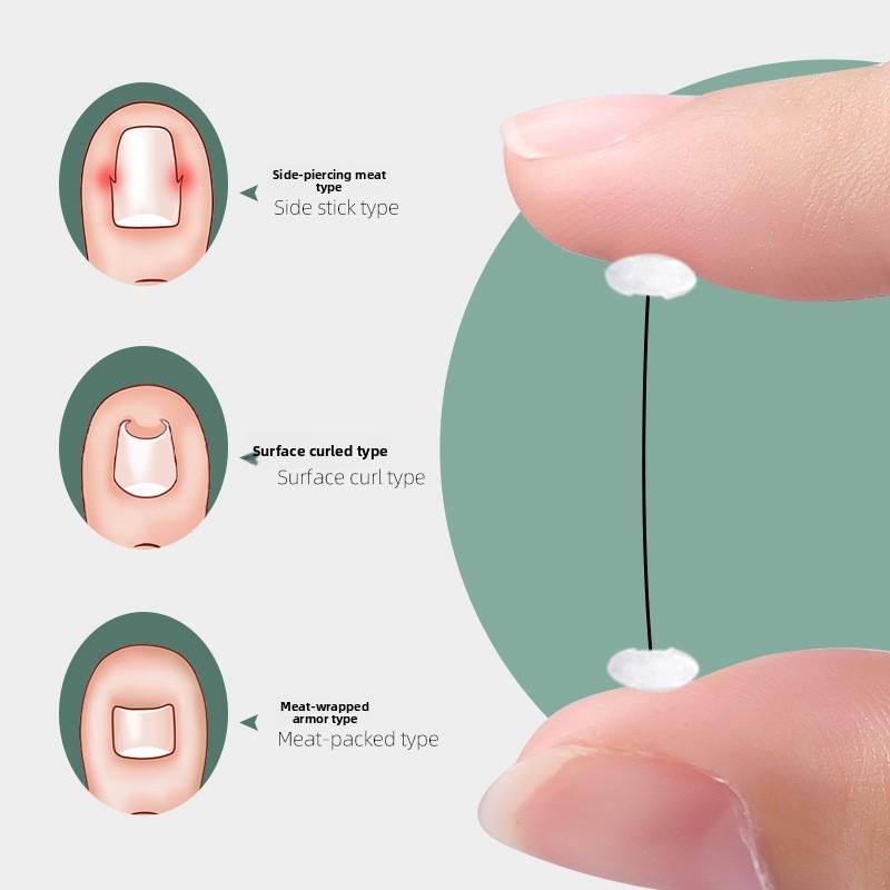 Lockige Nagelorthese Nickel-Chin-Legierung Memory-Rückprall Positiver Nagelkleber Nagelfalz Eingelegter Nagel Positiver Nagelpflaster Zehennagel Langes Fleisch