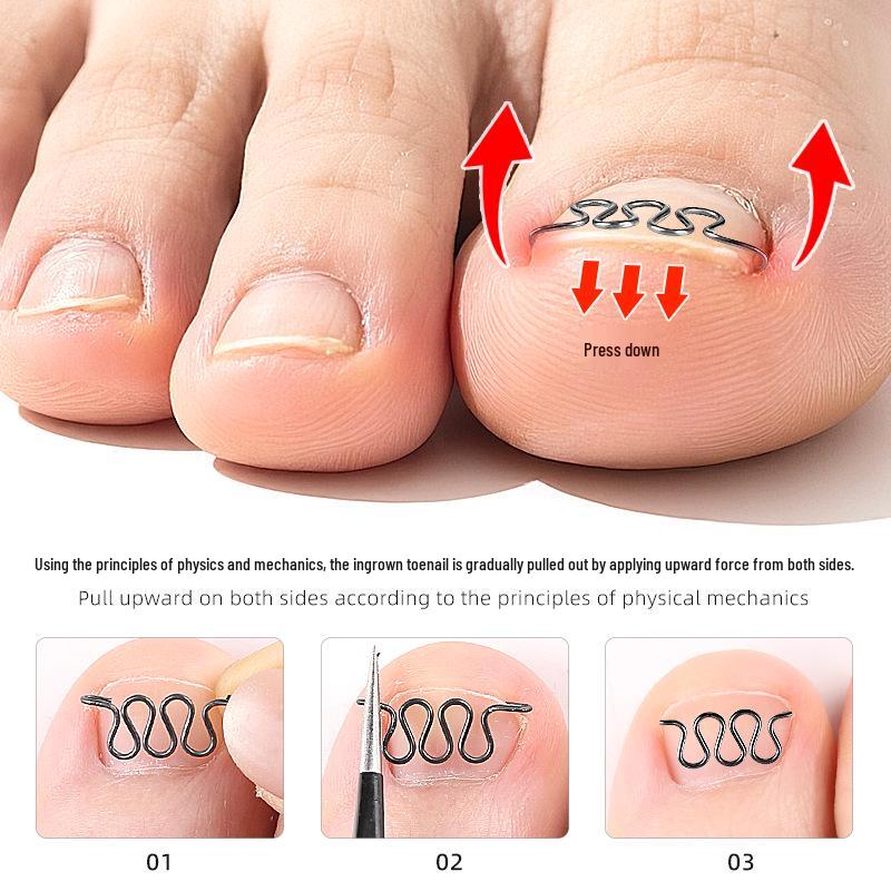 Stretchable Small Invisible Ingrown Toenail Patch with Nickel Alloy Coil Wire for Nail Correction, Fits in Shoes.