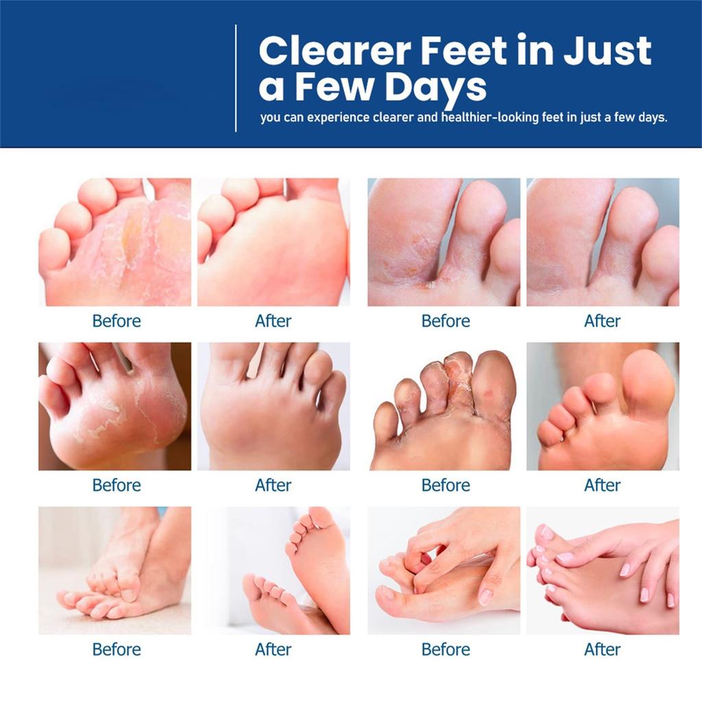 Athlete's Foot Care Cream Remove Feet Odor Itch Ointment Beriberi Foot Peeling Plaster30g