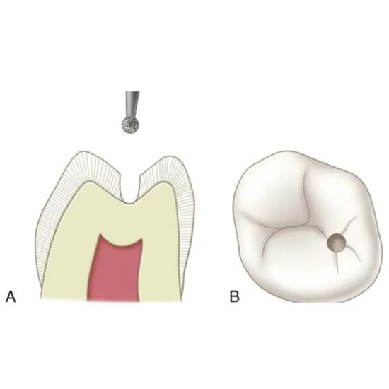 Mani Diamond Bur - Br-46 CA