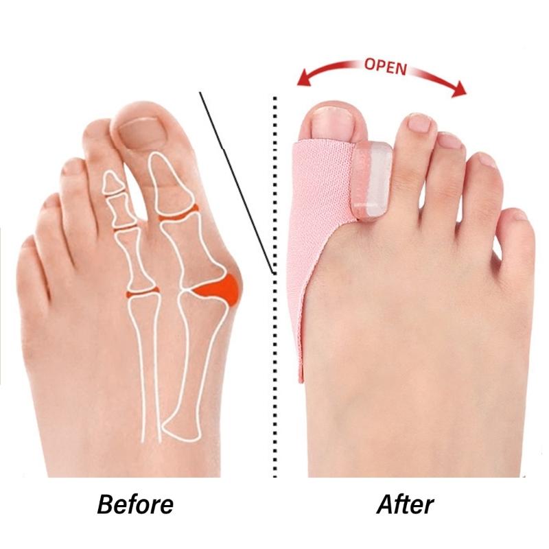 Big Toe Comfort Pads for Bunions Sufferers 8pcs Gel Cushions Toe Separator for Pains Relief and Foot Health