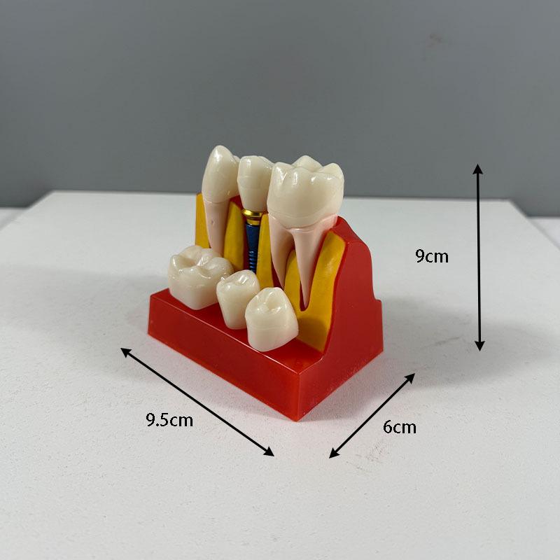 Прозора Знімна Повна Модель Щелепи з М'якими Яснами та Зубами для Підготовки до Імплантації