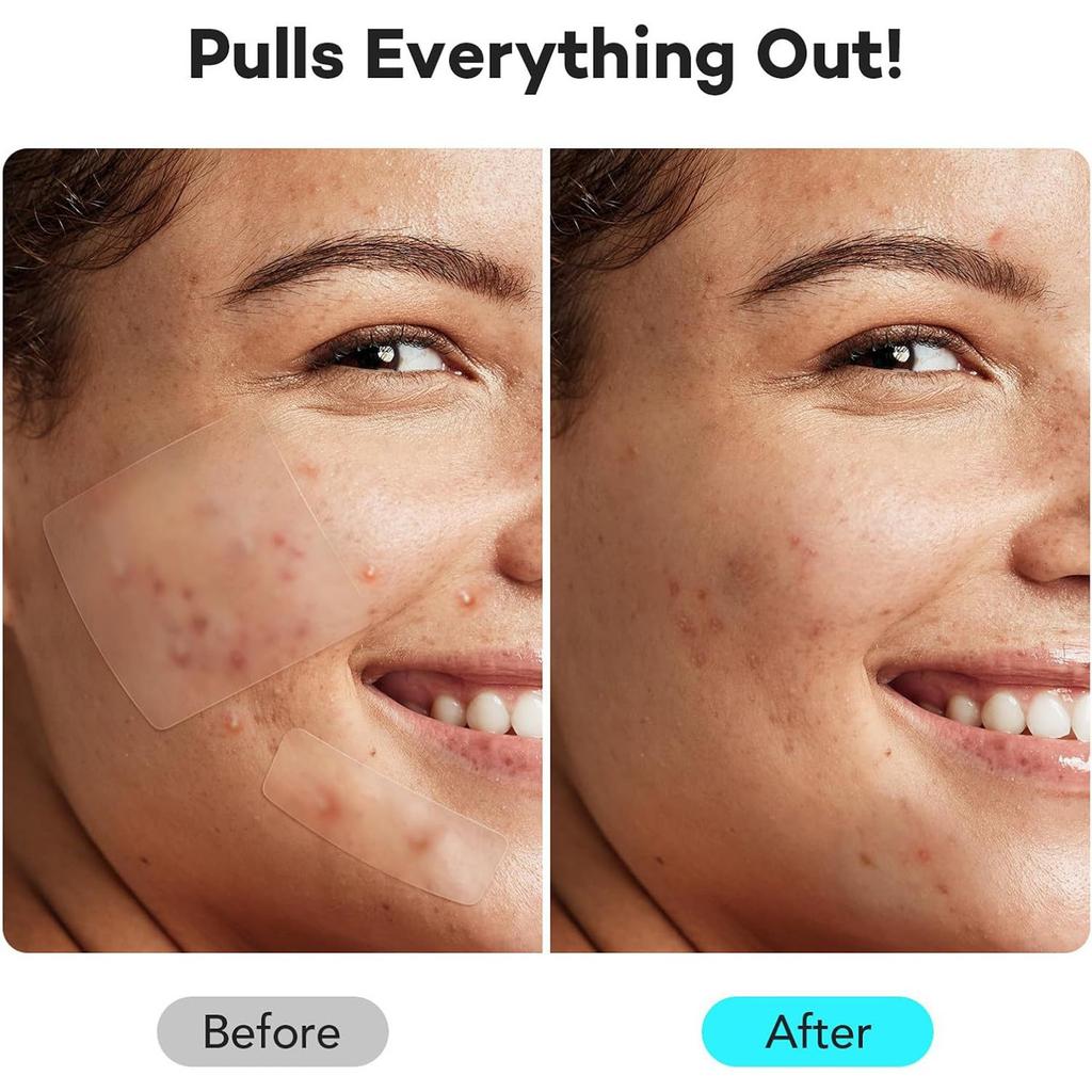 Akne-Patch Großpackung Pickel-Patches, Niedliche Pickelabdeckungen, Hydrokolloid-Akne-Patches mit Hyaluronsäure 262 Stück