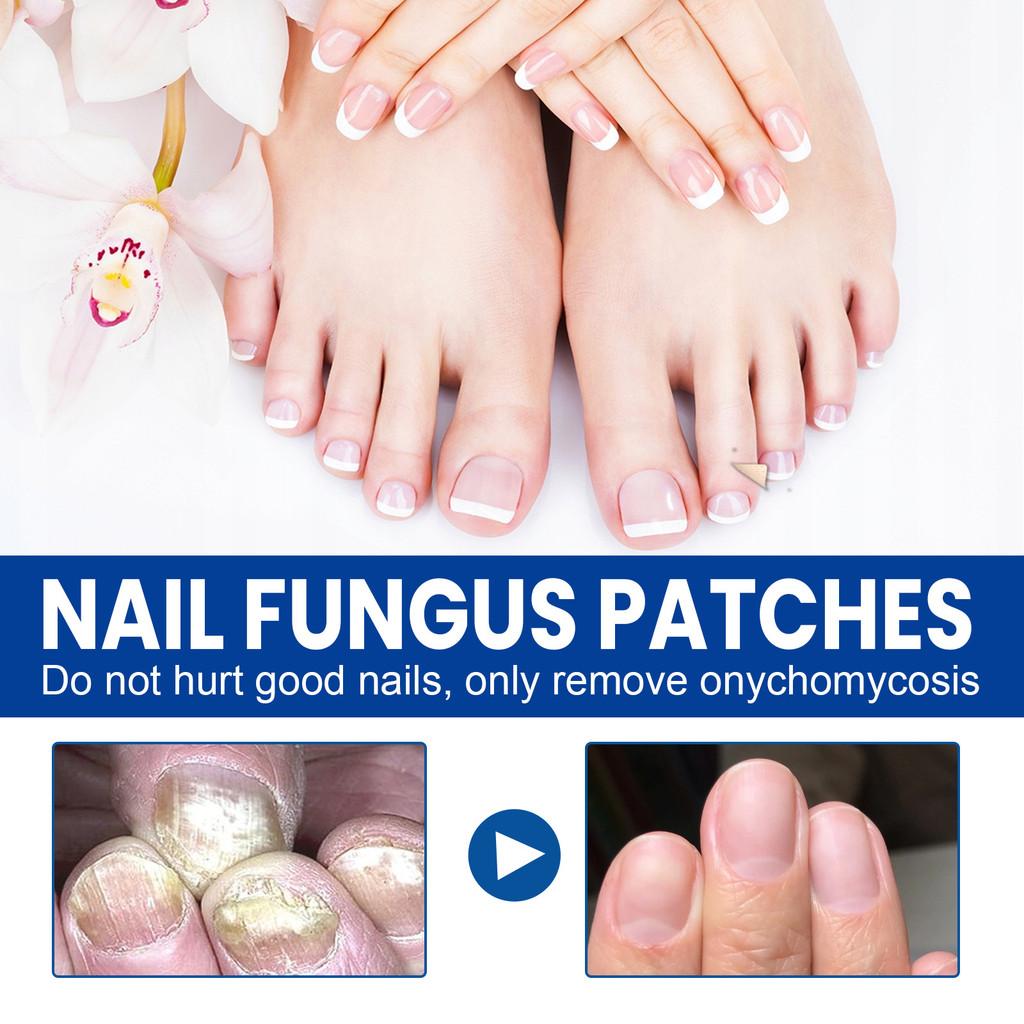 Ximonth Nail Care Patches Repairing Thickening Strengthening For Damaged Nails