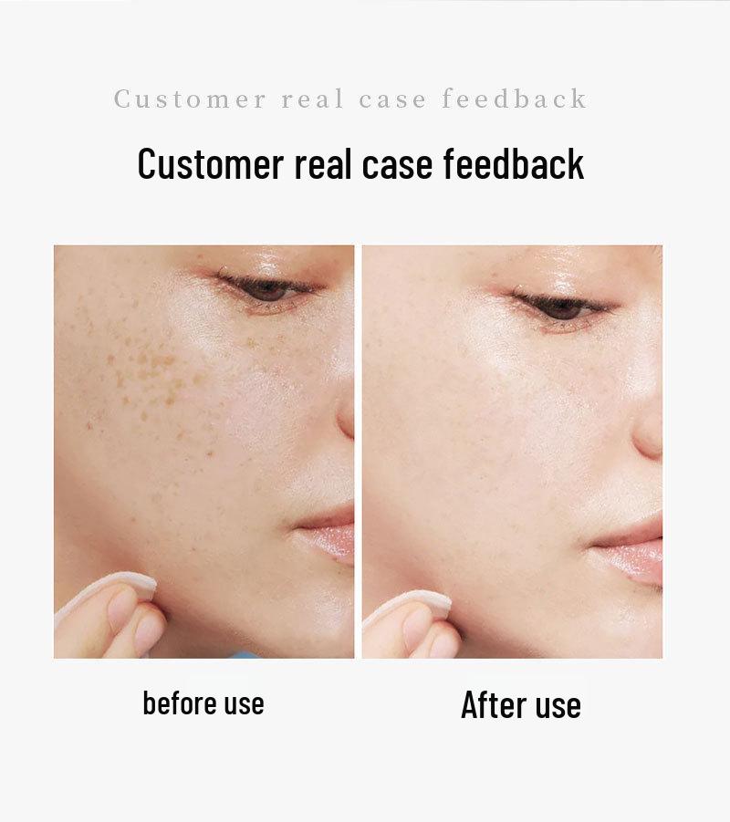 Freckle and Melasma Removal Solution for Salon: Pigment Decomposition & Whitening