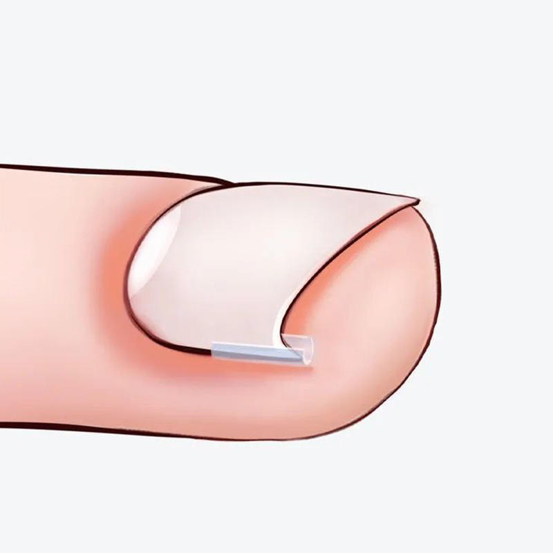 50PCS Ingrown Toenail Corrector Pads Kit Toenail Orthosis Corrector Strips Brace for Women Men