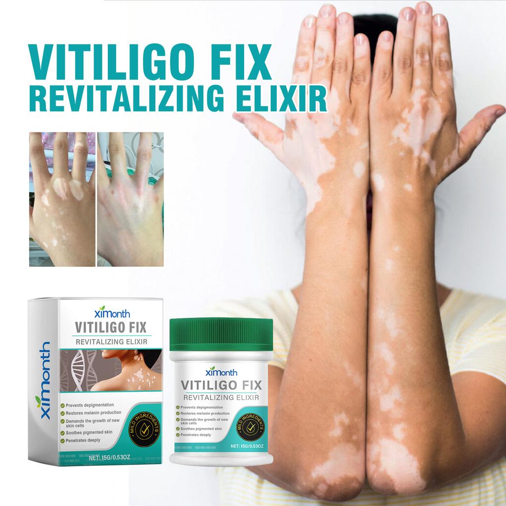 Ximonth Crema Trattamento Macchie Bianche Sbianca le Macchie Cutanee Uniforma il Tono della Pelle Lozione Idratante per la Cura del Corpo