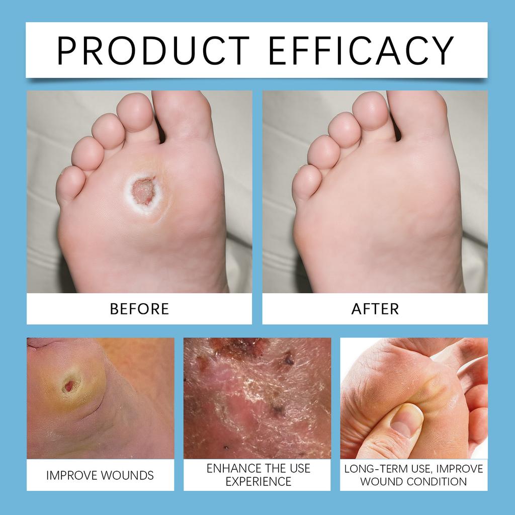 The Pen Promotes Blood Circulation And Assists In Epidermal . It Is Designed For Portable Home Use.