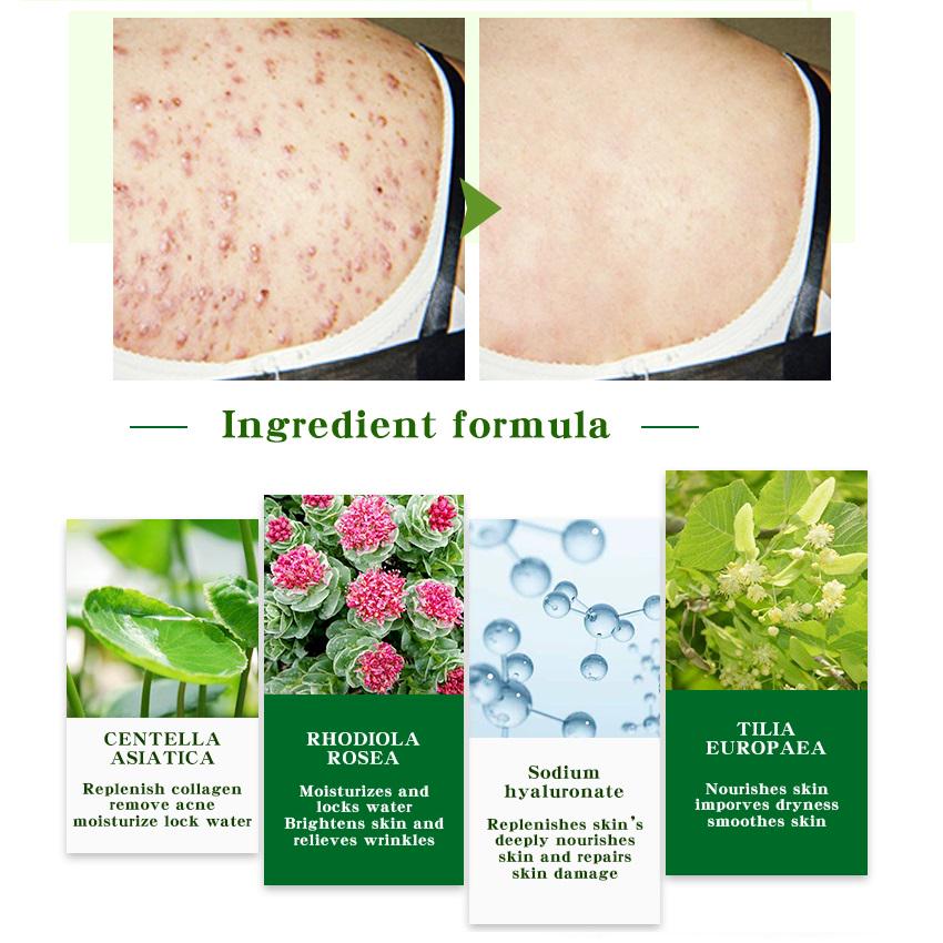 Oligopeptide Acne Clearing Serum Treatment Cream Pore Repair Anti Aging Moisturizing Essence