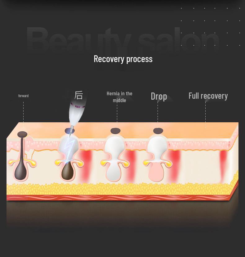 Picosecond Laser Mole & Spot Removal Device for Acne Scar Treatment