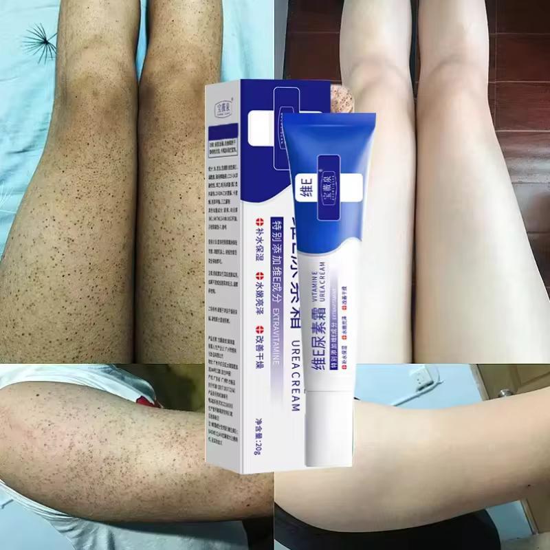 10% Urea Vitamin E Body Cream Moisturizing Hand Lotion for Dry Skin Keratosis Pilaris Treatment4.8414 Purchases