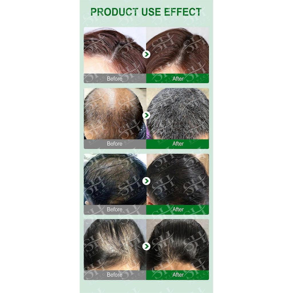 3pcs Rosemary Essential Oil Pure Natural Nourish Scalp Essential Oil Anti-Hair Loss Hair Growth