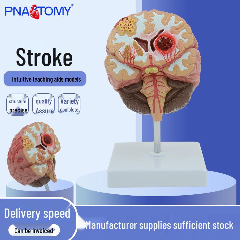 Cerebral Hemorrhage & AV Malformation Brain Anatomy Teaching Model 11 x 11 x 18 cm