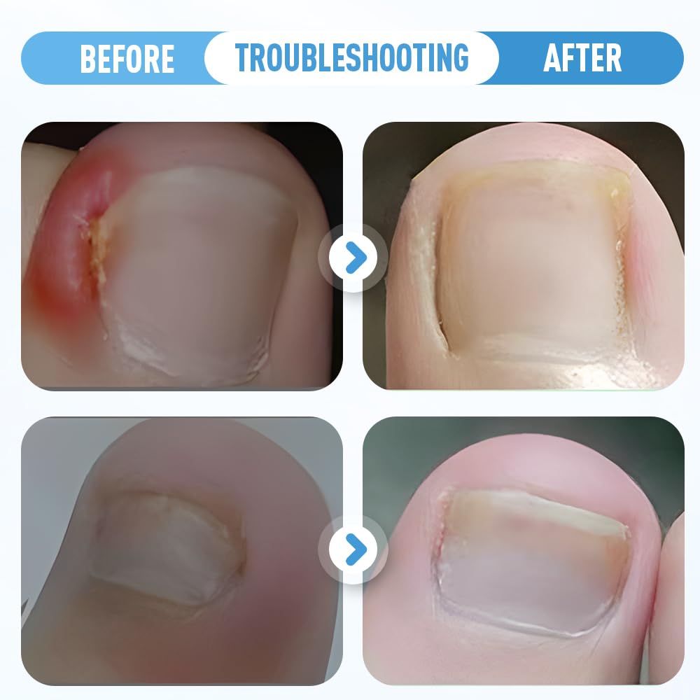 Professional Ingrown Toenail Set with Breathable Ingrown Toenail Strips, Curved Toenails Corrector Patch, Painless File and Lifter Pedicure Tools