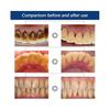 3x Dental Calculus Cleaning Halitosis Stone Type Remove Teeth Whitening Dental Cleaning Water Remove Peculiar Smell and Calculus