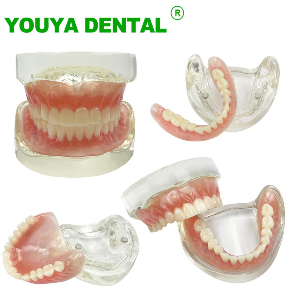 Modelo de Implante Dental 2 Implante Prótesis Completa Superior Inferior Modelo de Dientes Typodont Productos de Odontología Para Enseñanza Estudio