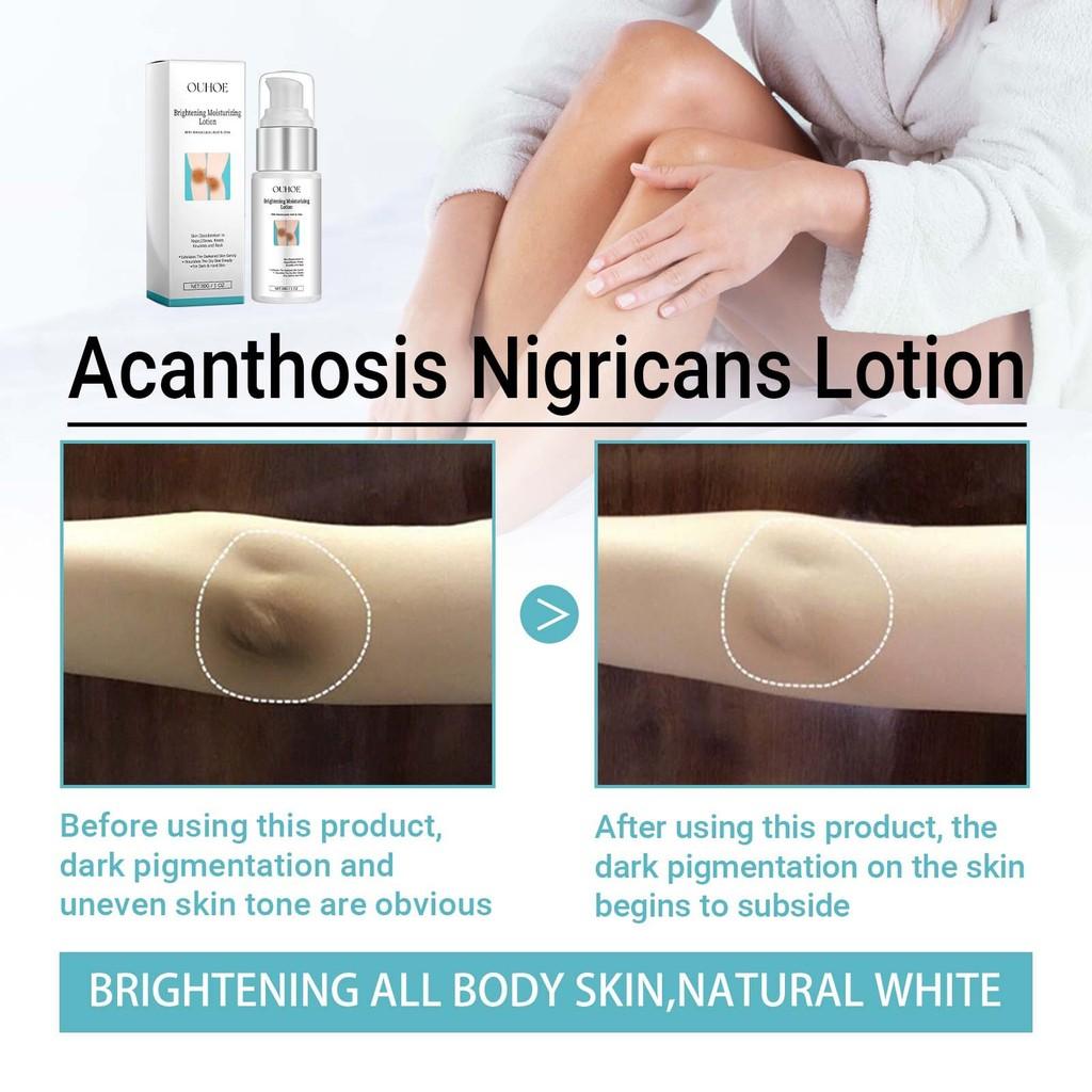 Ouhoe Nourishing Skin Whitening Cream For Underarms And Joints 30g Export Only