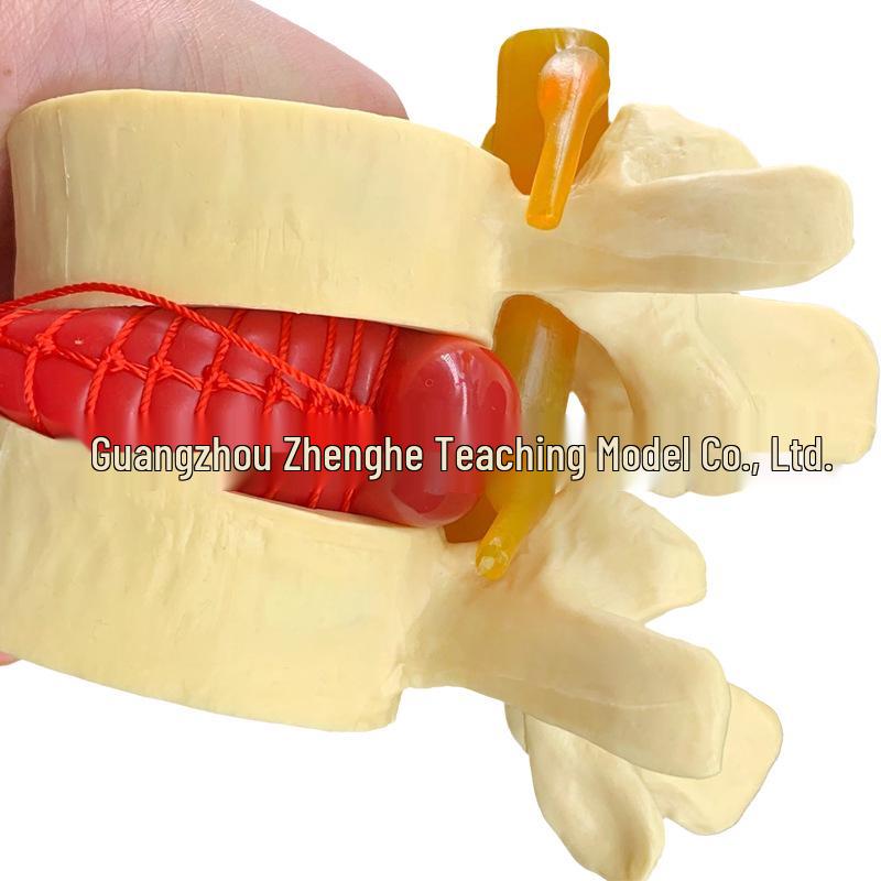 Human Lumbar Spine and Disc Lesion Demonstration Model: Vertebrae and Orthopedic Teaching Aid 12x12x10 cm