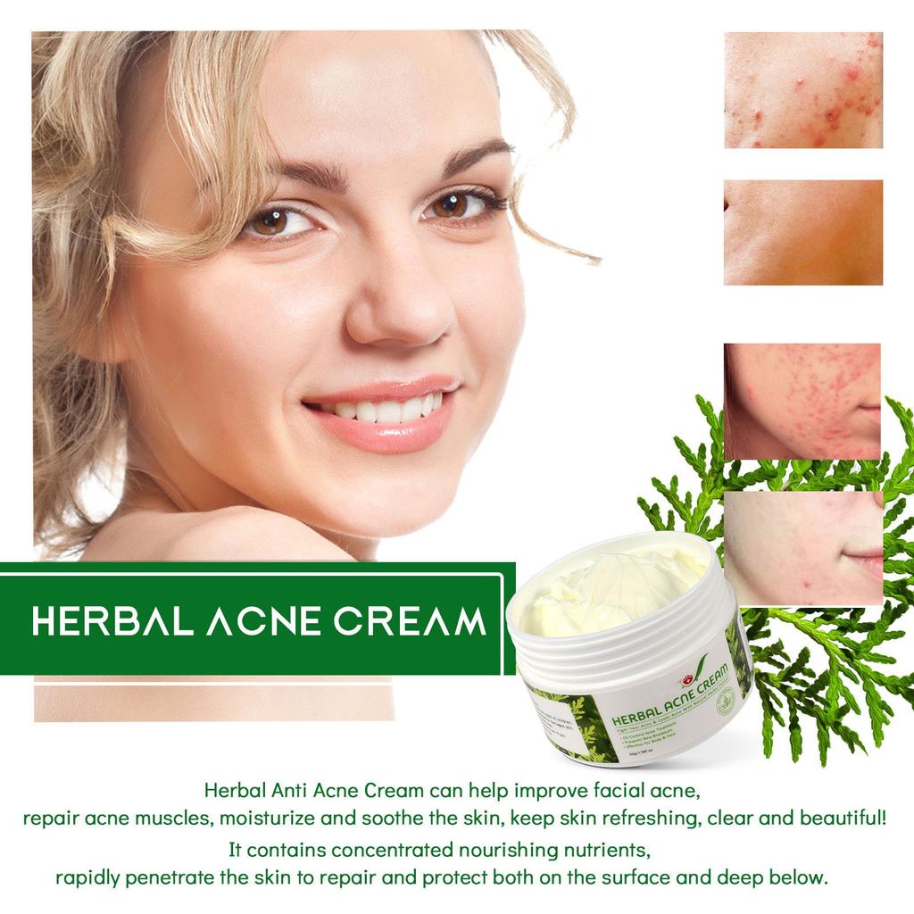 Herbal Acne Creams Anti-Pimple Creams Anti-Acne Creams Acne Balance Water And Oil Skin Blemishes Effective For Body And Face 50g
